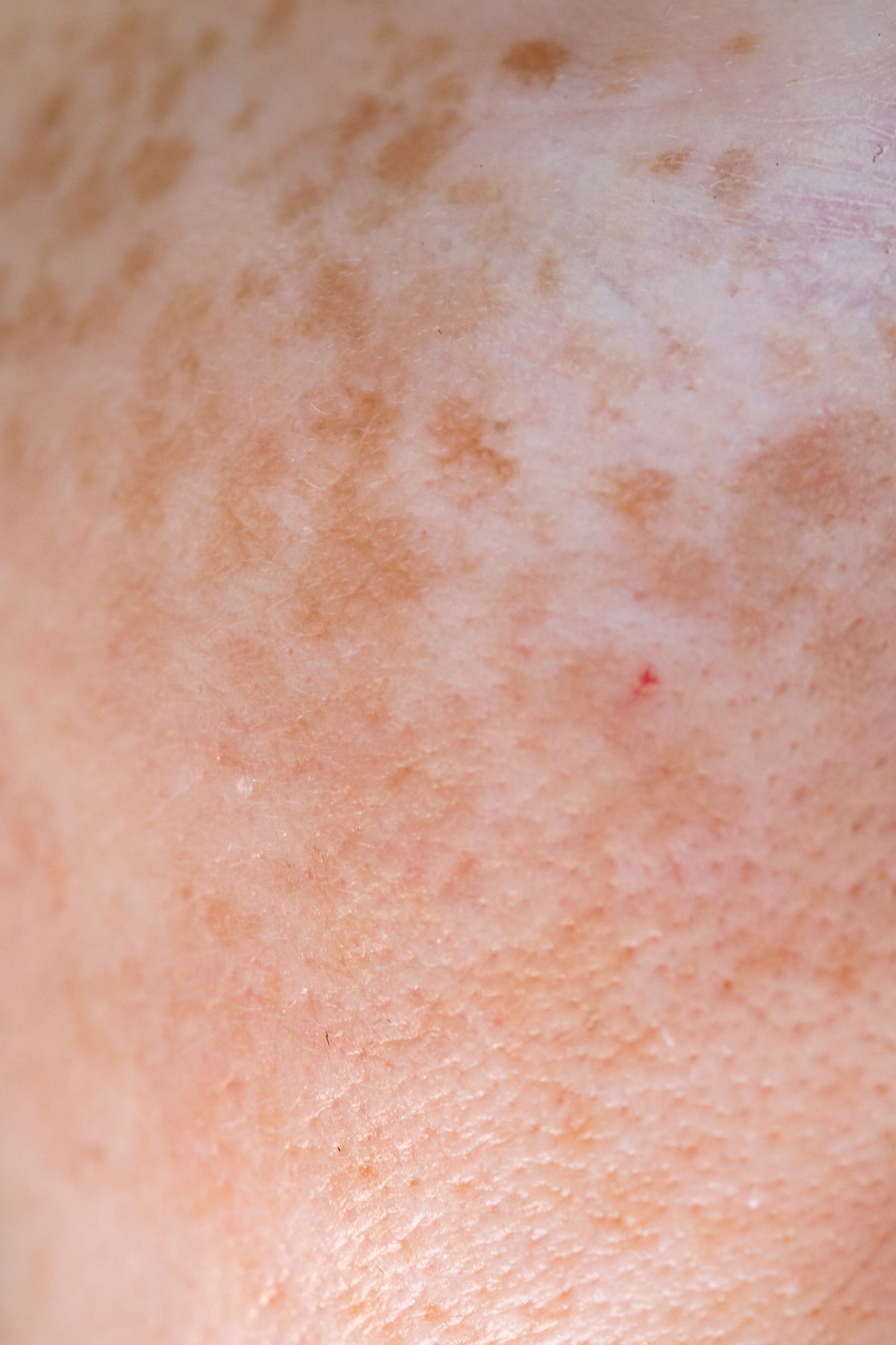 Taches brunes et hyperpigmentation : d'où elles viennent et comment les atténuer