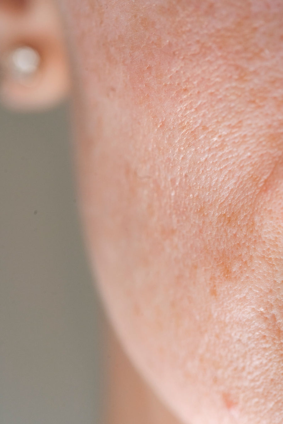 Rougeurs et rosacée : les déclencheurs à connaître et les soins à privilégier