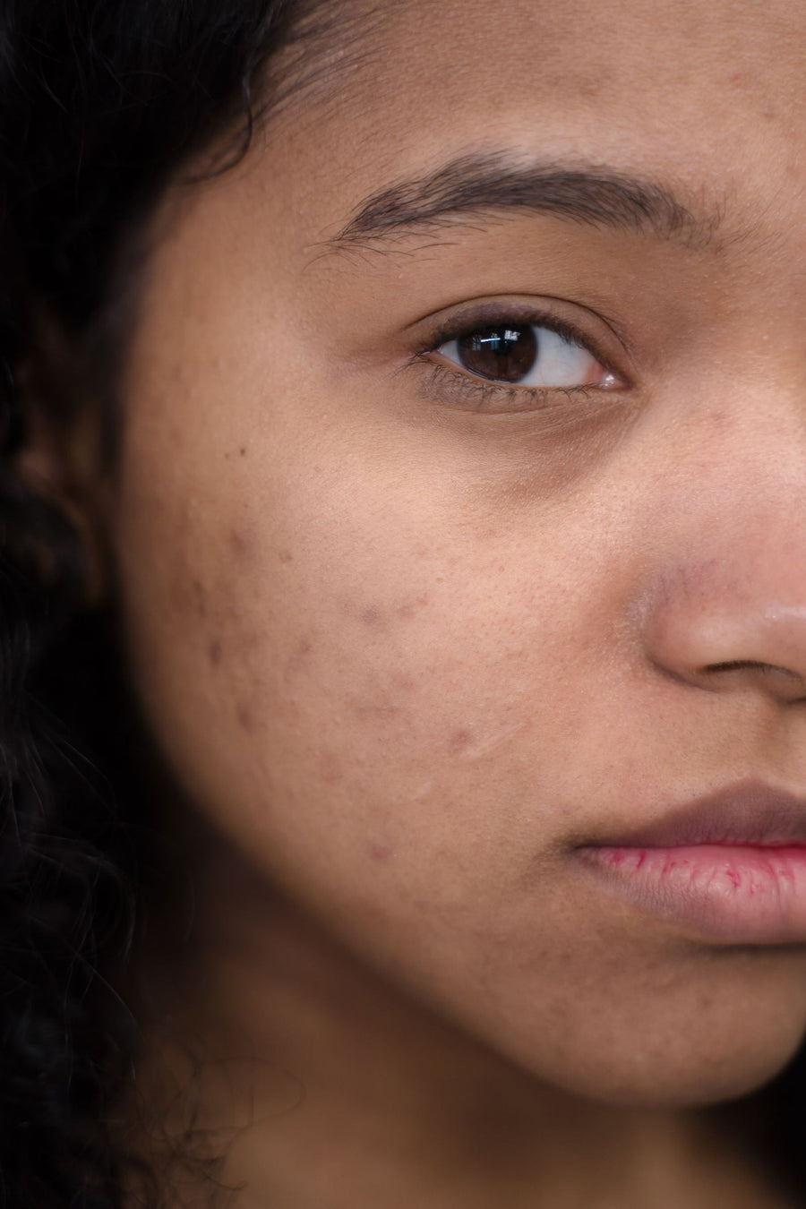 Points noirs et pores dilatés : pourquoi ils apparaissent et comment les atténuer